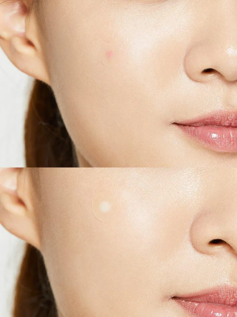 acne-pimple-master-patch-cosrx-official-5.webp